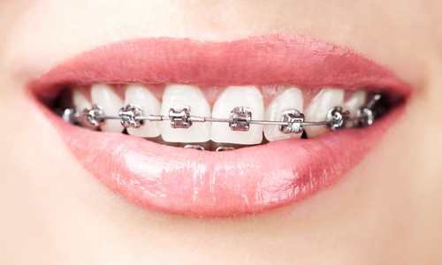 深圳牙齿排列不齐矫形多少钱？
