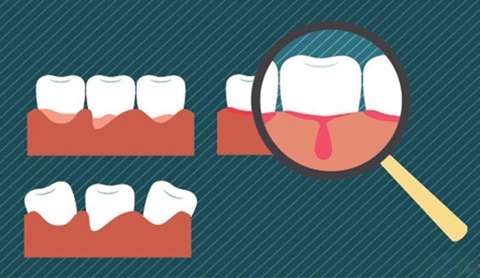 深圳牙龈出血怎样治疗？
