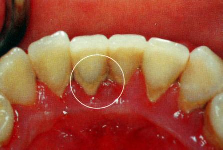 深圳牙结石的危害有哪些？