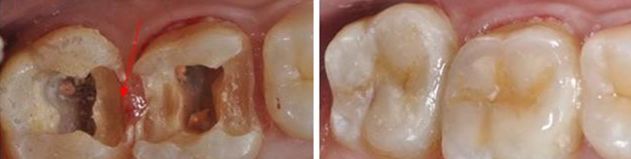 深圳牙齿缺损修复方法