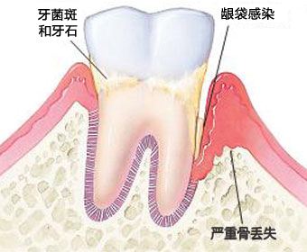 深圳牙菌斑该怎么去除？