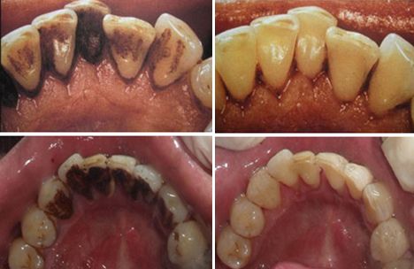 深圳洗牙能去除牙齿上的烟渍吗？