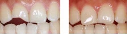 深圳牙齿细微缺损如何修复？