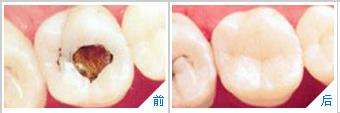 深圳蛀牙牙齿痛怎么办？