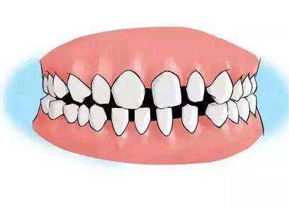 深圳牙齿稀疏是怎么回事？