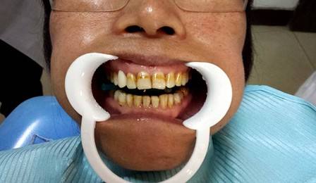 深圳怎样治疗氟斑牙？