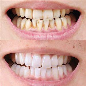 深圳黑牙黄牙美白方法有哪些？