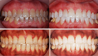 深圳四环素牙治疗方法有哪些？