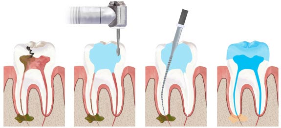 深圳牙齿根管治疗全过程