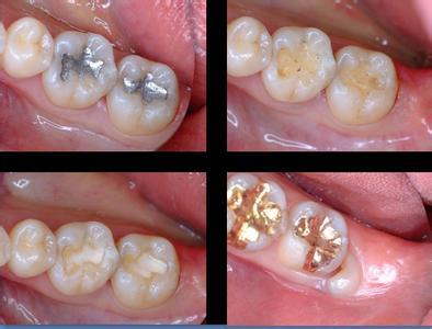 深圳龋牙治疗方法