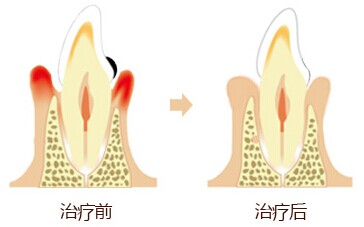 深圳怎样治疗牙周炎？