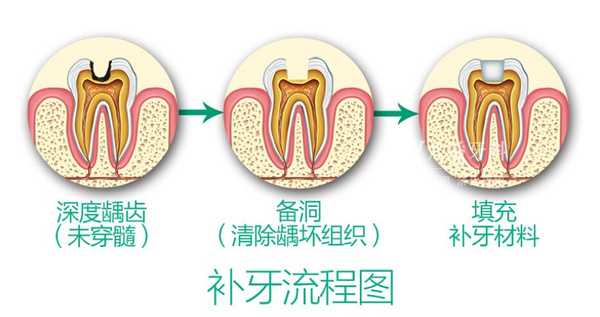 深圳儿童龋齿治疗过程