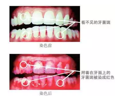 深圳牙菌斑是怎样产生的？