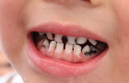 深圳儿童龋齿症状有哪些？
