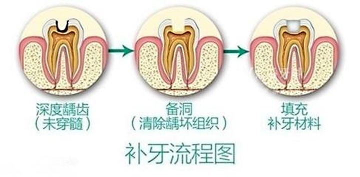 深圳医院补牙多少钱一颗？