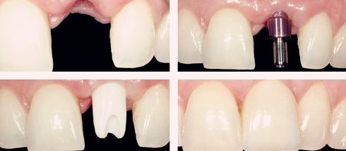 深圳种植牙齿手术过程