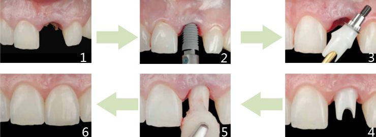 深圳种植牙齿手术安全吗？