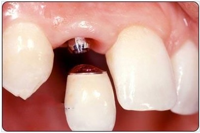 即刻种植牙与普通种植牙的区别有哪些？