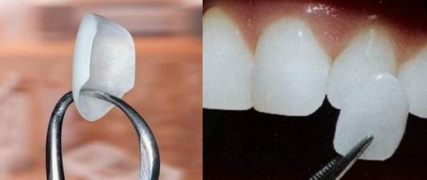 深圳牙齿贴面修复价格是多少？