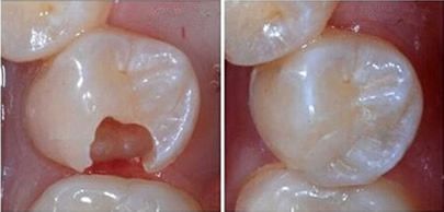 深圳牙齿缺损怎么治疗？