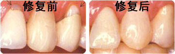 牙齿表面楔状缺损应该怎么办？
