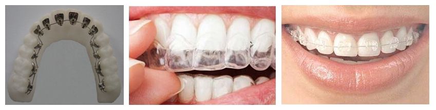 牙齿前突矫形方法有哪些？