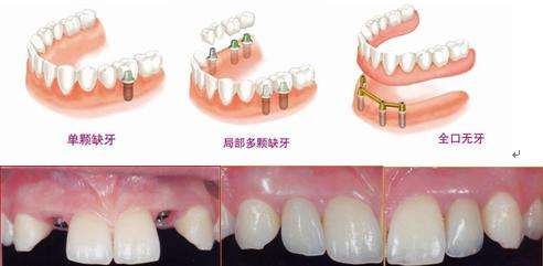 哪个牙科机构做种植牙比较好？
