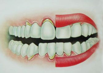 牙龈萎缩治疗方法有哪些？