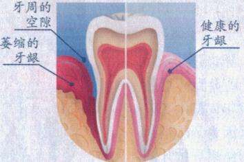 牙龈萎缩怎么治疗？有哪些方法？