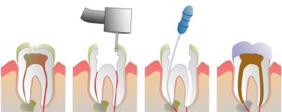 牙髓炎需要拔牙吗？应该怎么治疗？