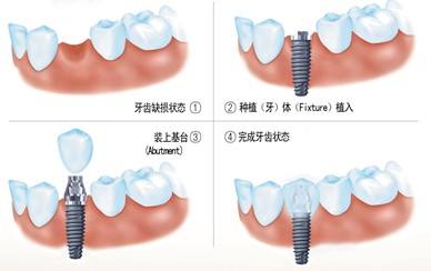 牙齿种植手术过程是怎样的？