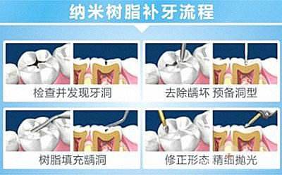 专业补牙过程是怎样的？