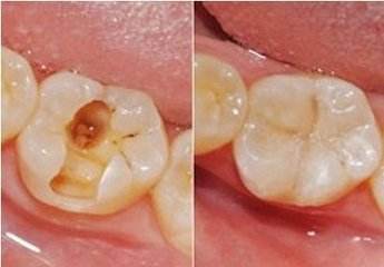 补牙一般需要多少钱？