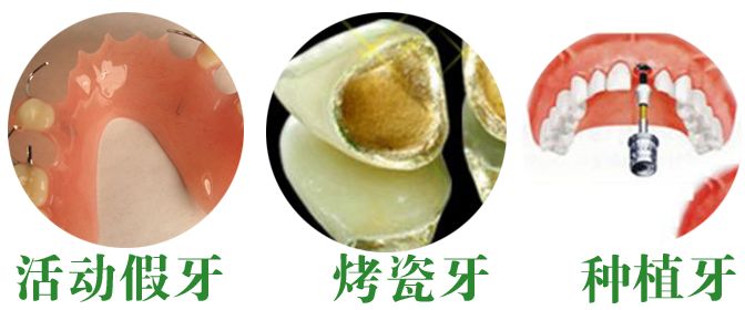 镶牙门牙需要多少钱? 镶牙门牙需要多少钱?