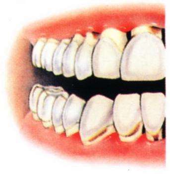 深圳如何治疗牙齿松动？