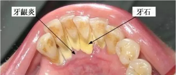 左氧氟沙星可以治疗牙龈炎吗？