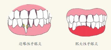 增生性牙龈炎的症状有哪些？