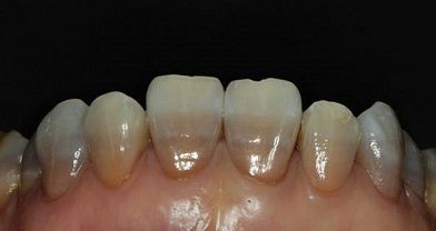 四环素牙的成因是什么？