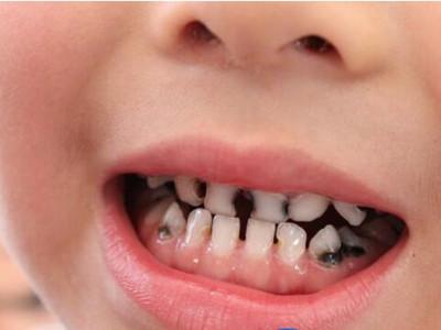 小孩子蛀牙不治疗有哪些危害？