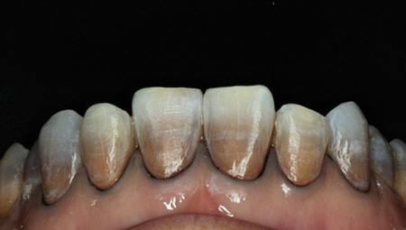四环素牙会遗传吗？