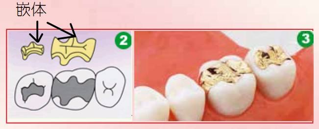 牙齿楔状缺损怎么办？