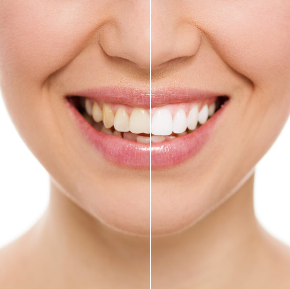 黑黄牙美白有哪些方法？