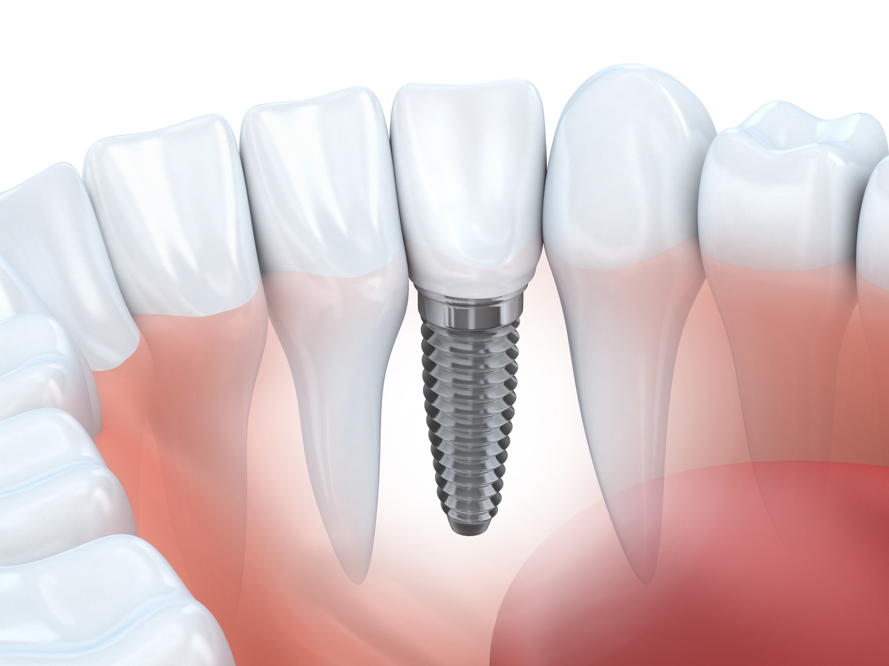 什么是种植牙修复？深圳种植牙修复怎么收费？