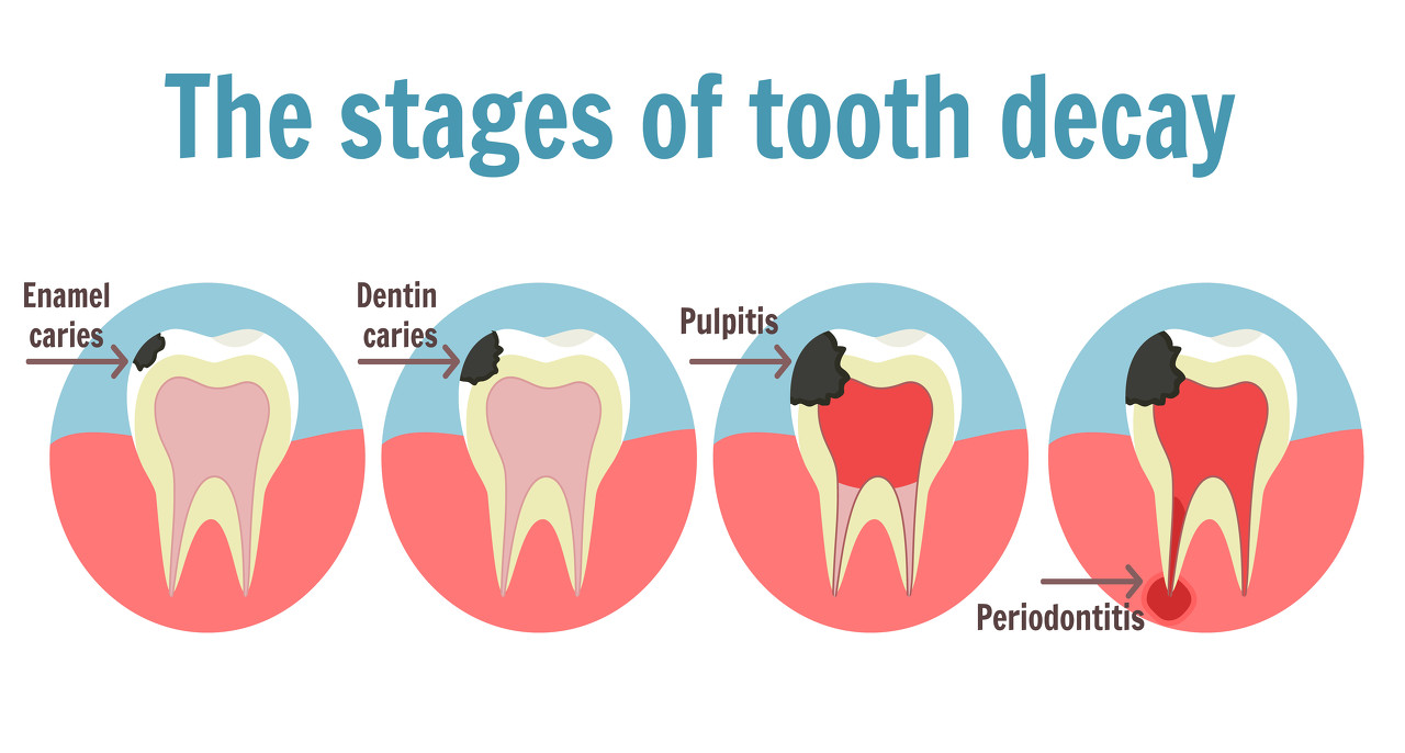 儿童牙齿龋齿怎么办？深圳儿童牙齿窝沟封闭多少钱？