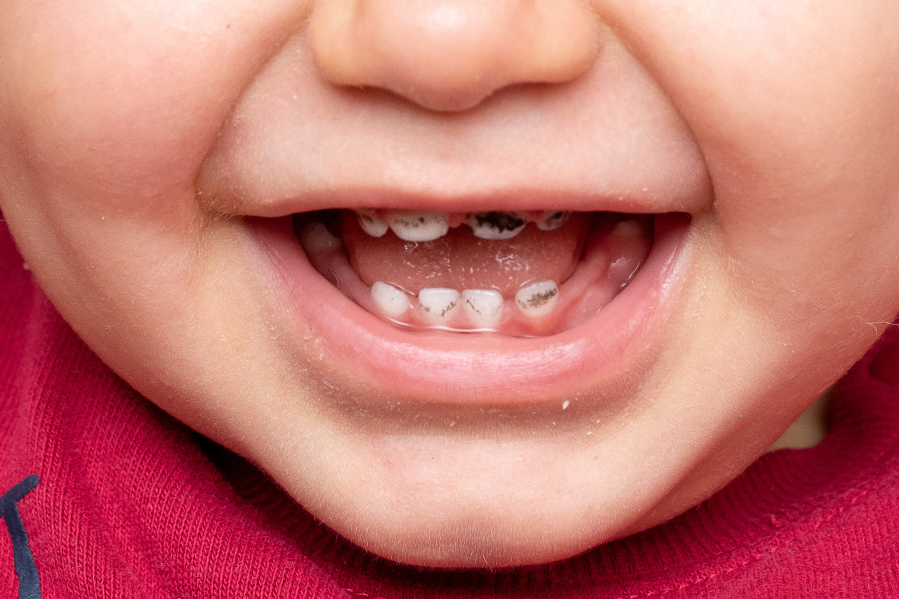两岁多宝宝牙疼是怎么回事？罗湖儿童牙科哪家好？