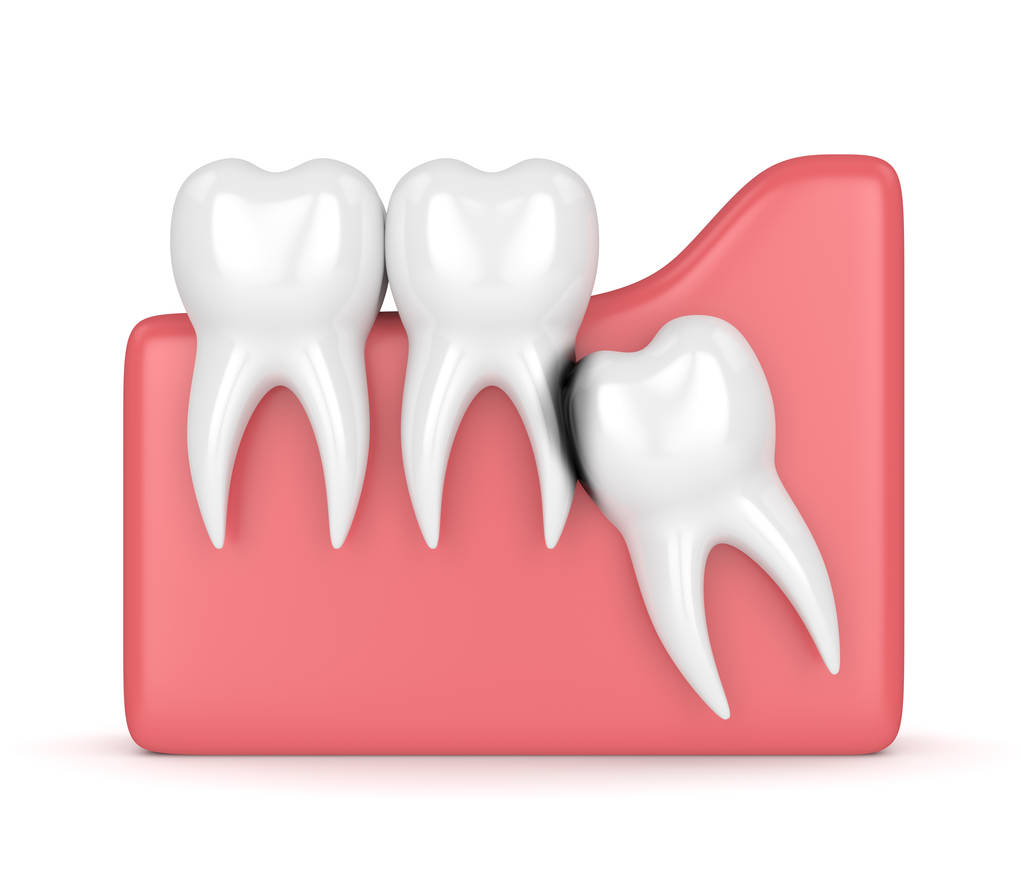 智齿冠周炎的症状有哪些？深圳智齿牙拔掉多少钱？