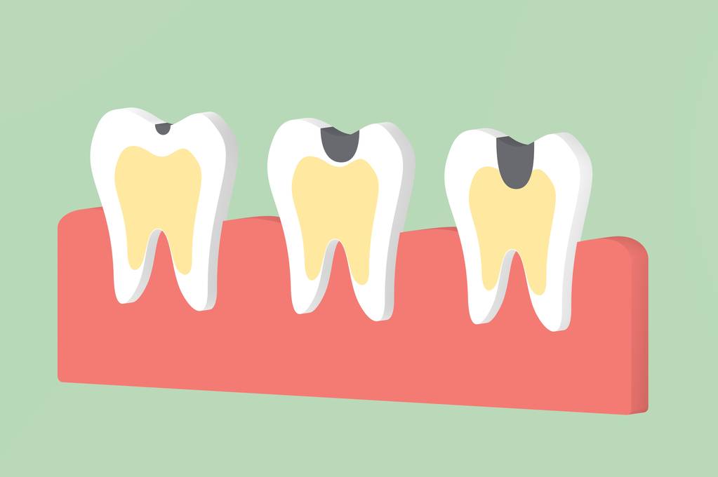 补牙后牙疼是什么原因？补牙后的注意事项有哪些?