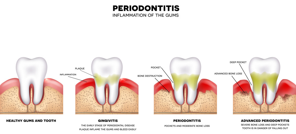 牙周炎是怎么引起的？牙周炎的治疗方法？