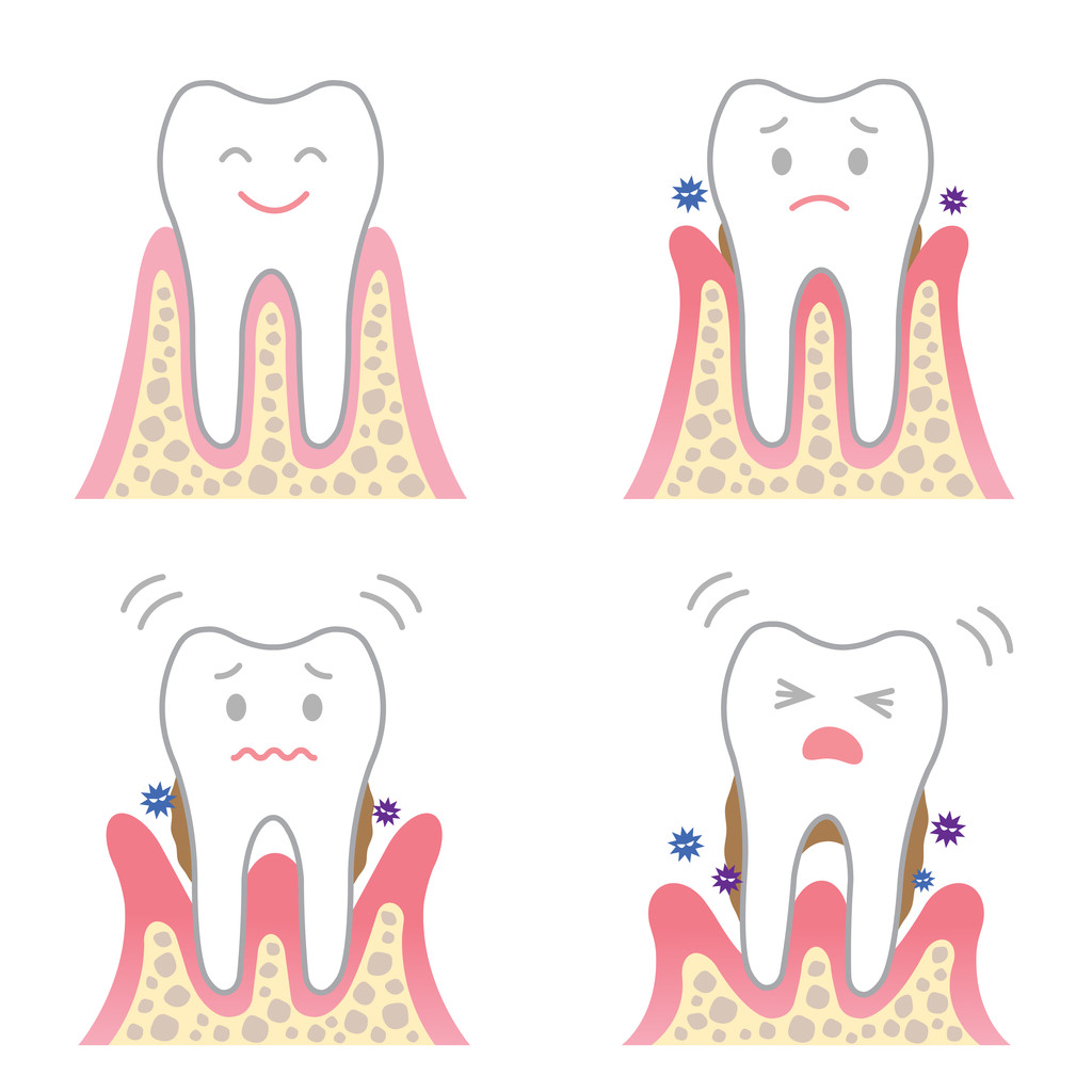 牙龈炎和牙周炎有什么区别？牙龈炎和牙周炎怎么治疗？