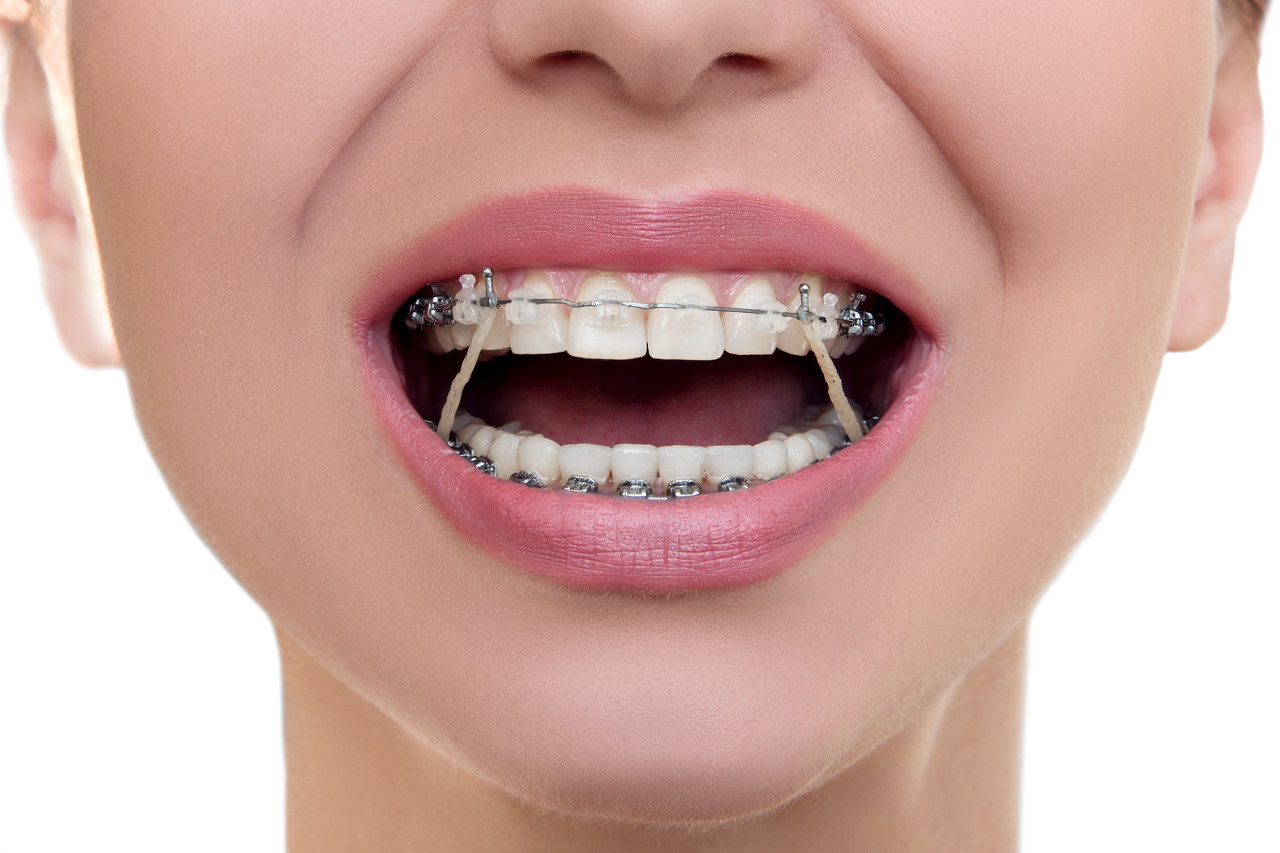 骨钉是什么？骨钉在牙齿矫正中的作用是什么？